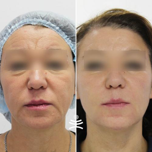 Аппаратная косметология для омоложения лица. Аппаратные процедуры