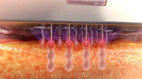 Израильский аппарат для RF-лифтинга. Безоперационное омоложение игольчатый RF-лифтинг Morpheus 8 (InMode, Израиль)