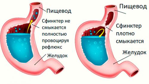 Опыт лечения гастроэзофагеальной рефлюксной болезни. Терапевтические аспекты гастроэзофагеальной рефлюксной болезни 02