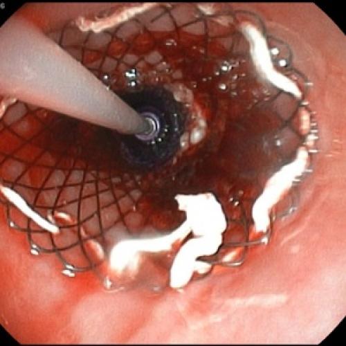 Что едят при панкреатите. «Запретные» продукты: от чего при панкреатите следует отказаться 13