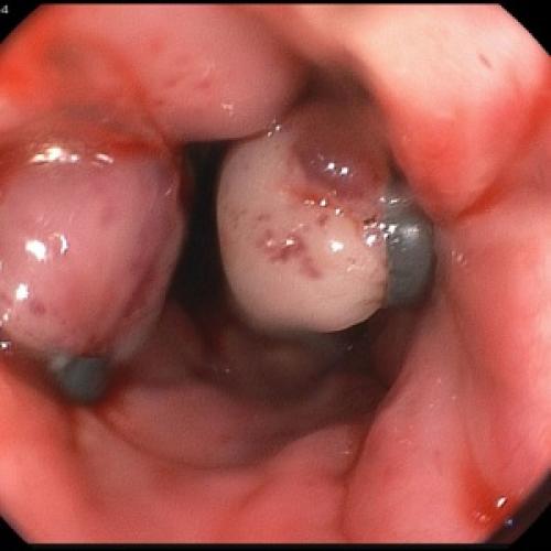 Что едят при панкреатите. «Запретные» продукты: от чего при панкреатите следует отказаться 14