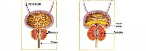 Сексуальные нарушения при хроническом простатите. Симптомы простатита 01 Сексуальные нарушения при хроническом простатите. Симптомы простатита 01