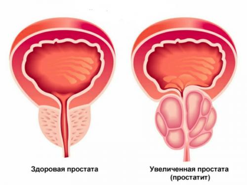 Симптомы и лечение хронического простатита. Методы лечения простатита 03 Симптомы и лечение хронического простатита. Методы лечения простатита 03
