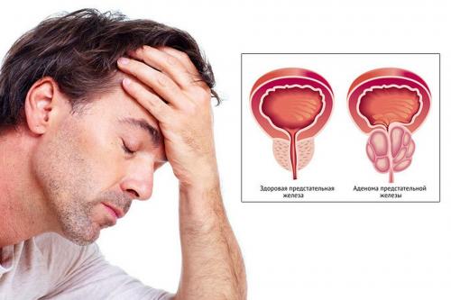 Диета при простатите аденоме. Диета при интерстициальном цистите 05 Диета при простатите аденоме. Диета при интерстициальном цистите 05