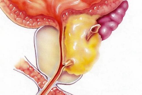 Новейшее лекарство от простатита. Таблетки от простатита