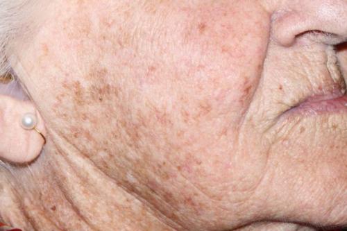 Как убрать возрастные пигментные пятна. Симптомы гиперпигментации кожи 05 Как убрать возрастные пигментные пятна. Симптомы гиперпигментации кожи 05