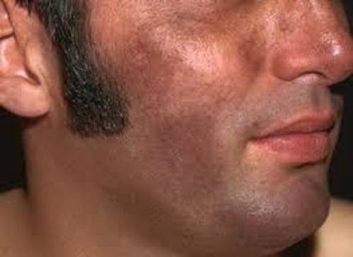 Как убрать возрастные пигментные пятна. Симптомы гиперпигментации кожи 07 Как убрать возрастные пигментные пятна. Симптомы гиперпигментации кожи 07