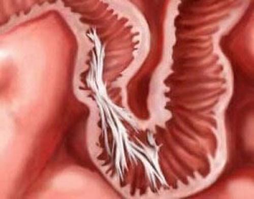 Диета после операции на кишечнике. Удаление полипов в кишечнике 01