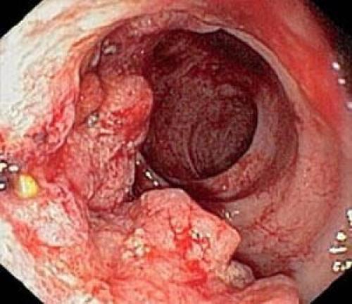 Диета после операции на кишечнике. Удаление полипов в кишечнике 02