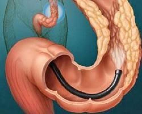 Диета после операции на кишечнике. Удаление полипов в кишечнике 03